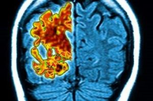 Battling Alzheimer’s Disease with Artificial Intelligence