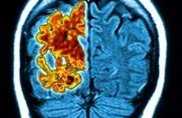 Battling Alzheimer’s Disease with Artificial Intelligence